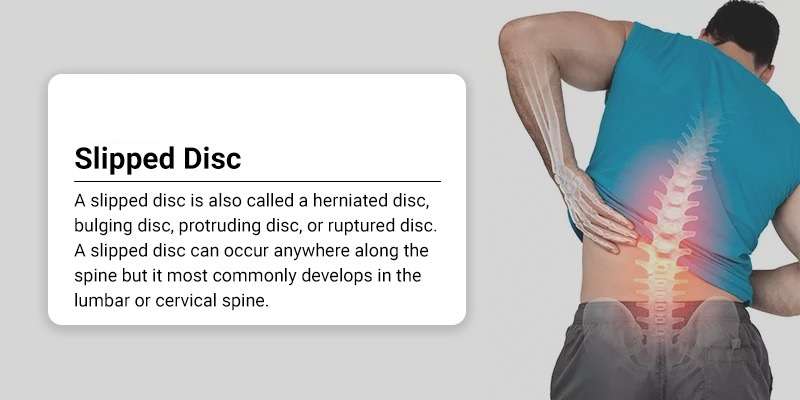 how to get a slipped disc back in place